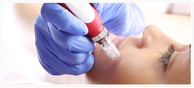 Le MICRO-NEEDLING : Un soin revitalisant complet pour votre peau-75_- dr Azoulay