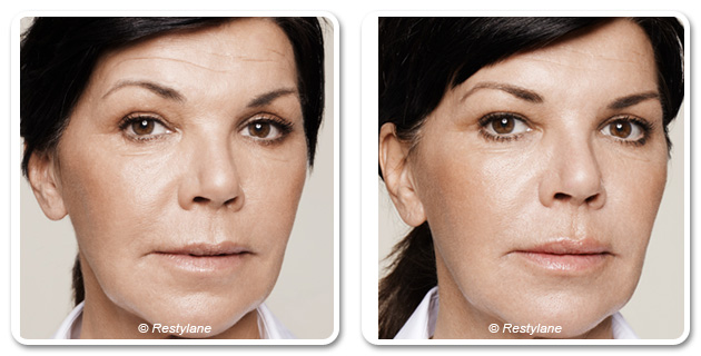 LES SKINBOOSTERS™ « un visage éclatant au naturel » - Dr Azoulay , médecine esthétique à Paris
