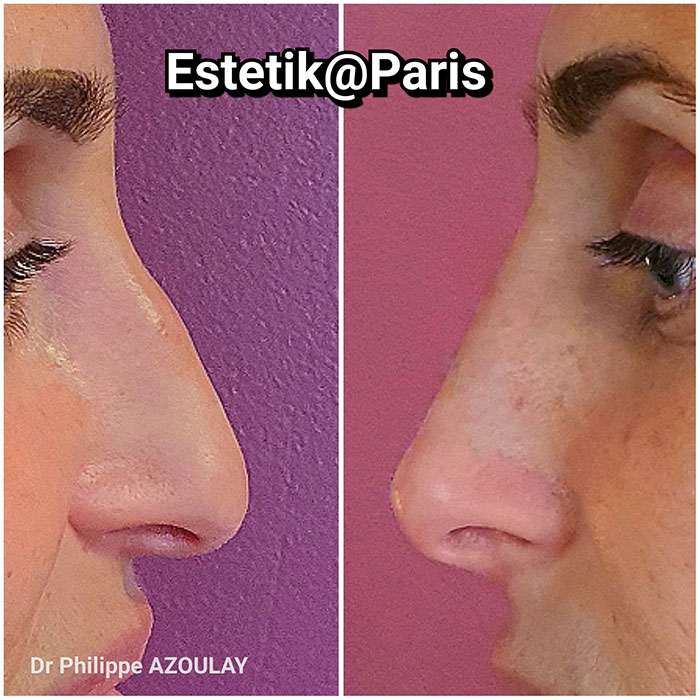 Rhinoplastie médicale à Boulogne - Avant - Après - Dr Azoulay