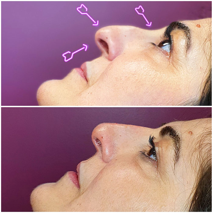 Rhinoplastie médicale à Boulogne - Avant - Après - Dr Azoulay