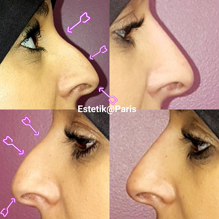 Rhinoplastie médicale à Boulogne - Avant - Après - Dr Azoulay