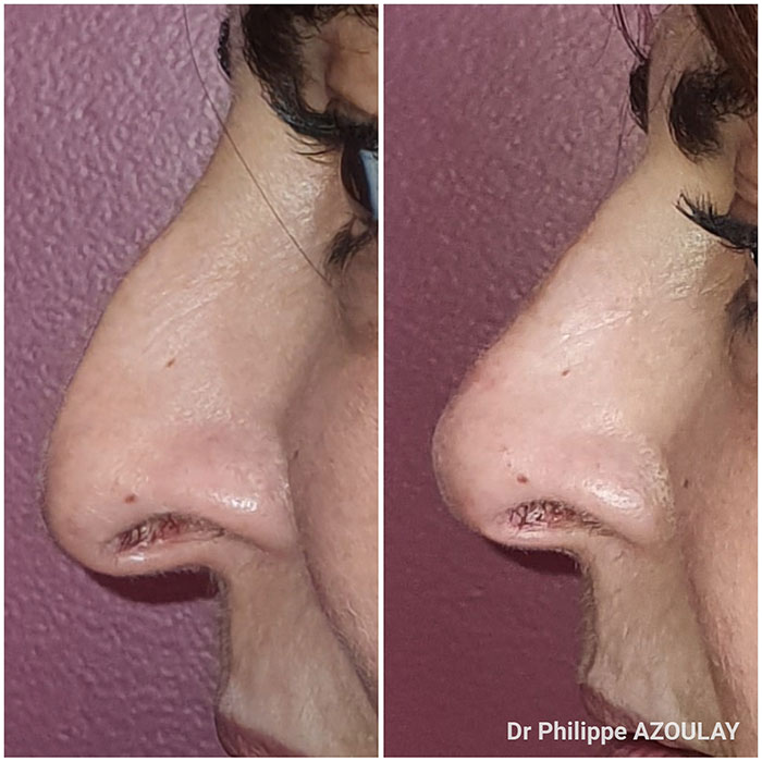 Rhinoplastie médicale à Boulogne - Avant - Après - Dr Azoulay