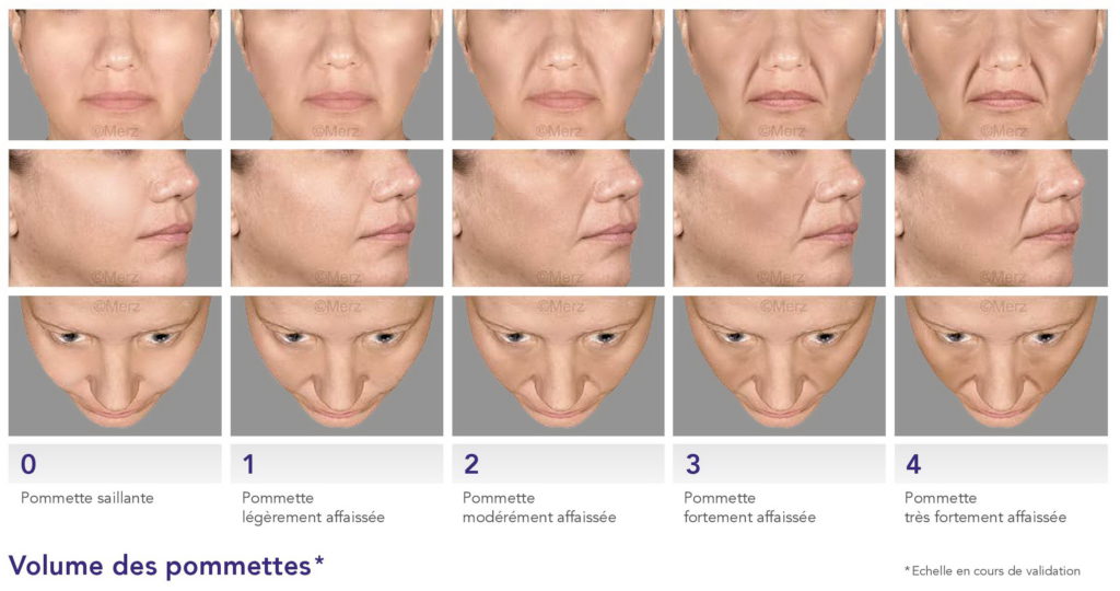 Le vieillissement du visage - Dr Azoulay, médecine esthétique à Boulogne