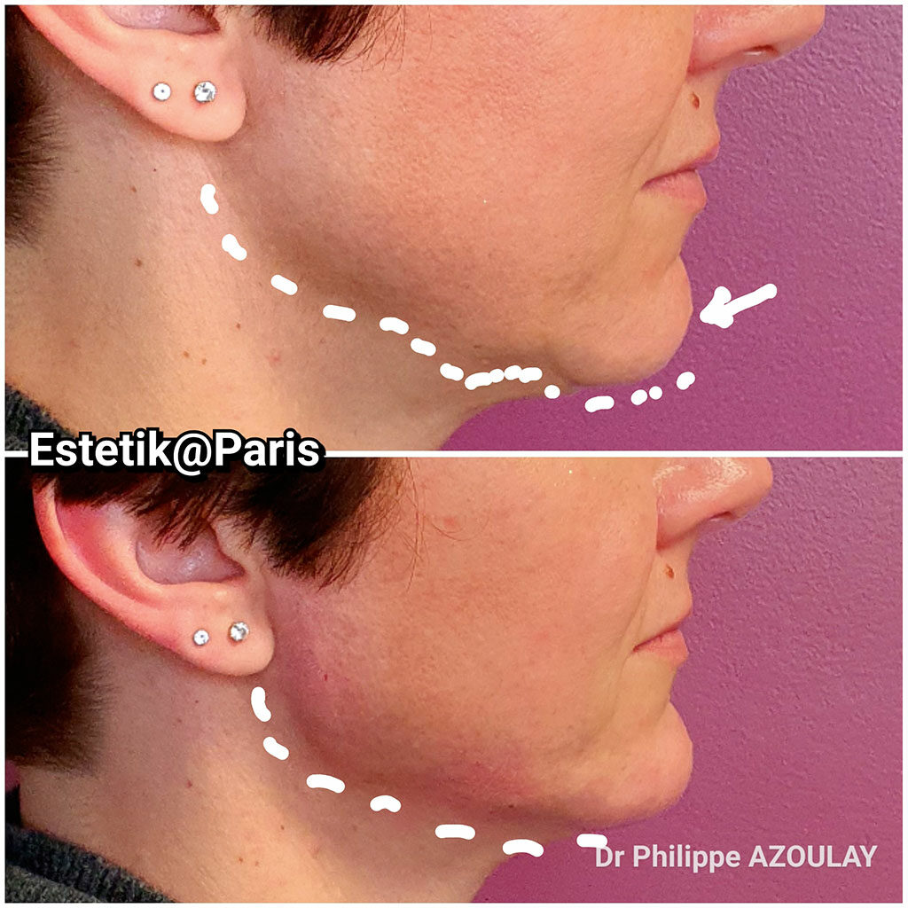 Le Jawline Contouring : Rendre la mâchoire plus carrée et donner