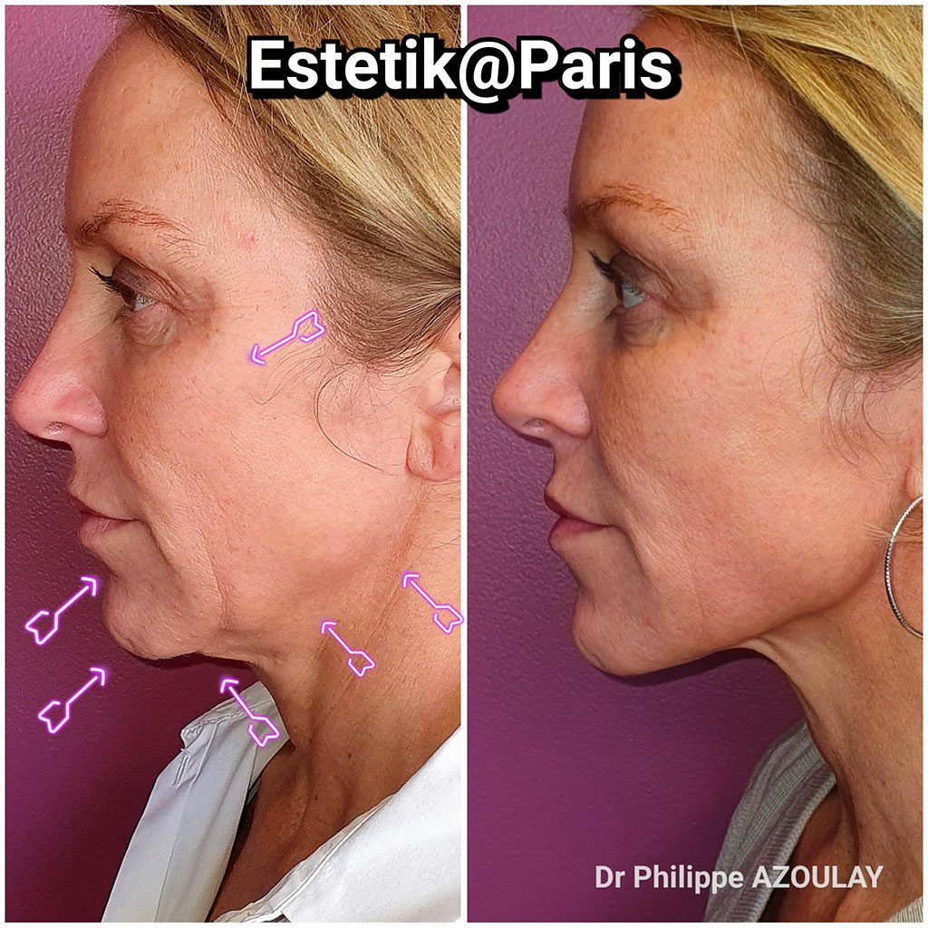 Jawline Contouring, nouvelle tendance US - Dr Azoulay à Paris