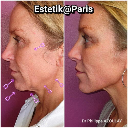Jawline Contouring - Dr Philippe Azoulay