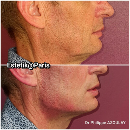 Jawline Contouring - Dr Philippe Azoulay