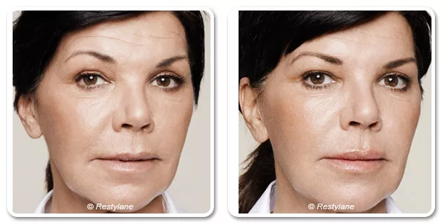 LES SKINBOOSTERS™ « un visage éclatant au naturel » - Dr Azoulay , médecine esthétique à Paris