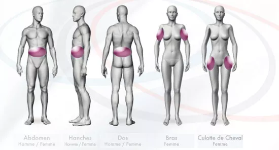 CRYOSLIM®, Cryolipolyse dernière génération - Dr Azoulay
