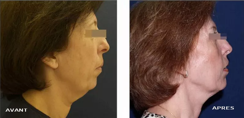 avant/après traitement de radiofréquence chez le dr Azoulay à Paris