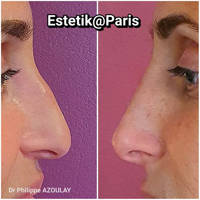 Rhinoplastie médicale à Boulogne - Avant - Après - Dr Azoulay