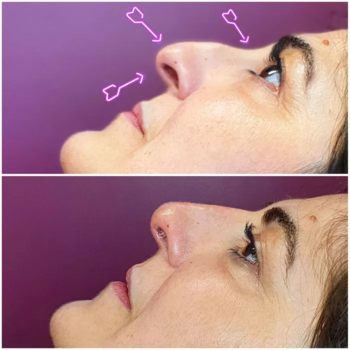 Rhinoplastie médicale à Boulogne - Avant - Après - Dr Azoulay