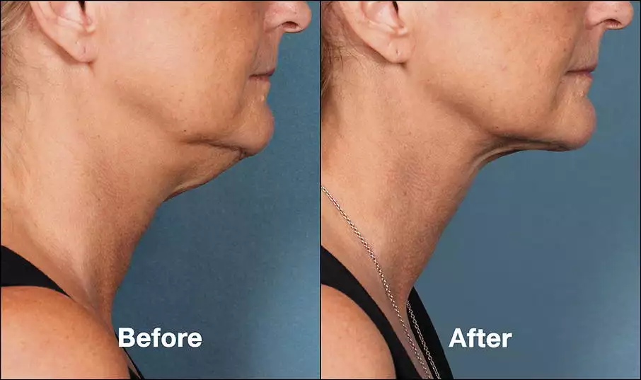 avant/après traitement du Double Menton Par Kybella chez le dr Azoulay à Paris