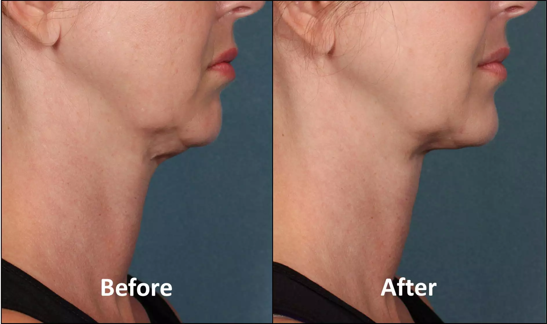 avant/après traitement du Double Menton Par Kybella chez le dr Azoulay à Paris