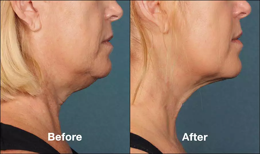 avant/après traitement du Double Menton Par Kybella chez le dr Azoulay à Paris