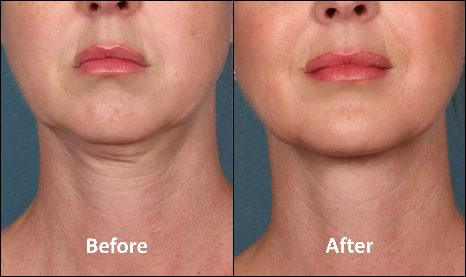 avant/après traitement du Double Menton Par Kybella chez le dr Azoulay à Paris