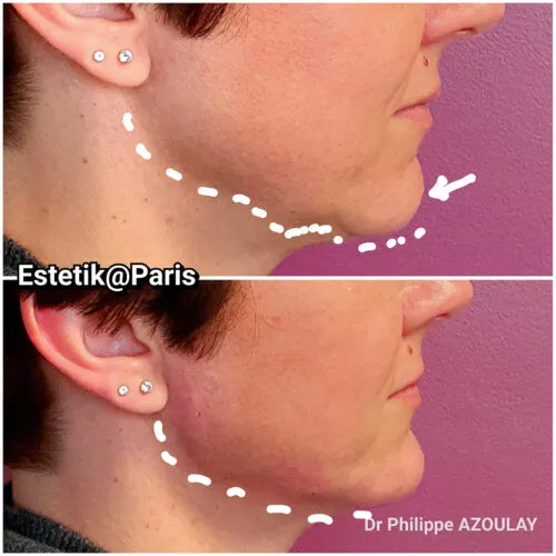 Jawline Contouring - Dr Philippe Azoulay