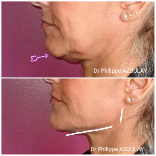 Jawline Contouring - Dr Philippe Azoulay