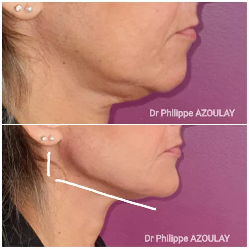 Jawline Contouring - Dr Philippe Azoulay